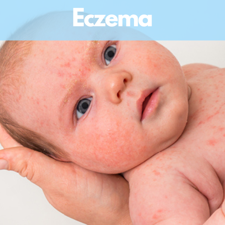 ECZEMA